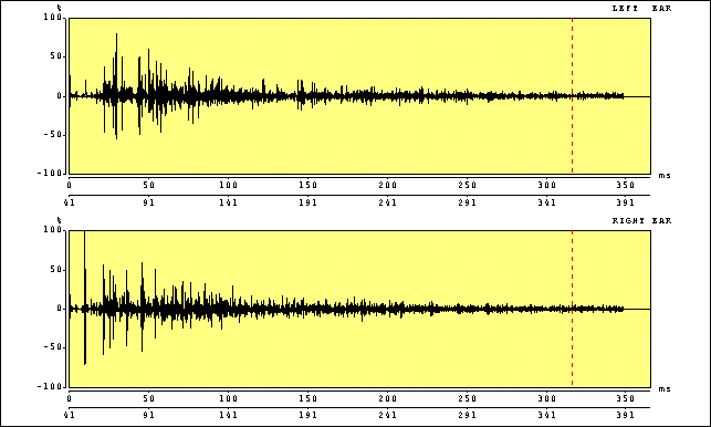 impulse response of anechoic room